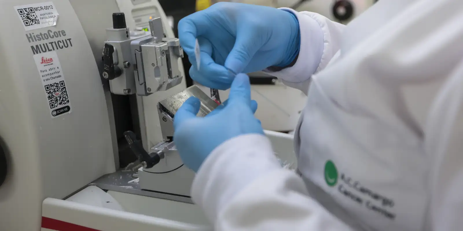 SUS incorpora venetoclax e azacitidina para leucemia mieloide aguda em adultos