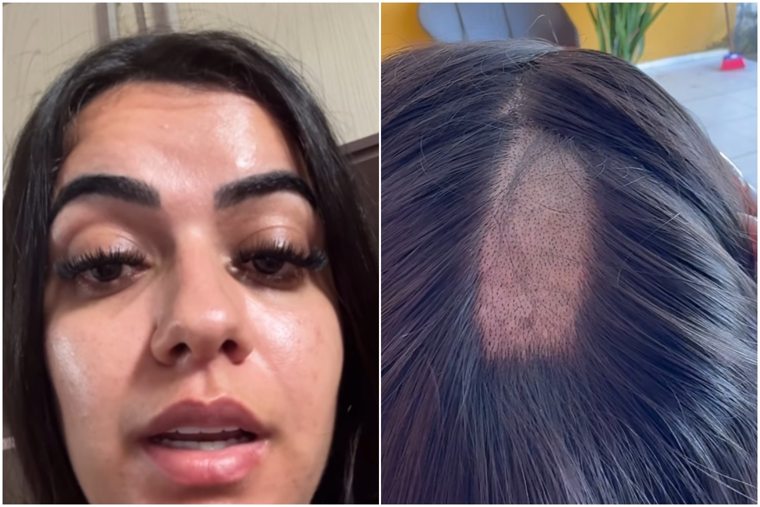 Mulher com cabeça raspada em exame toxicológico para CNH recebe apoio de laboratório