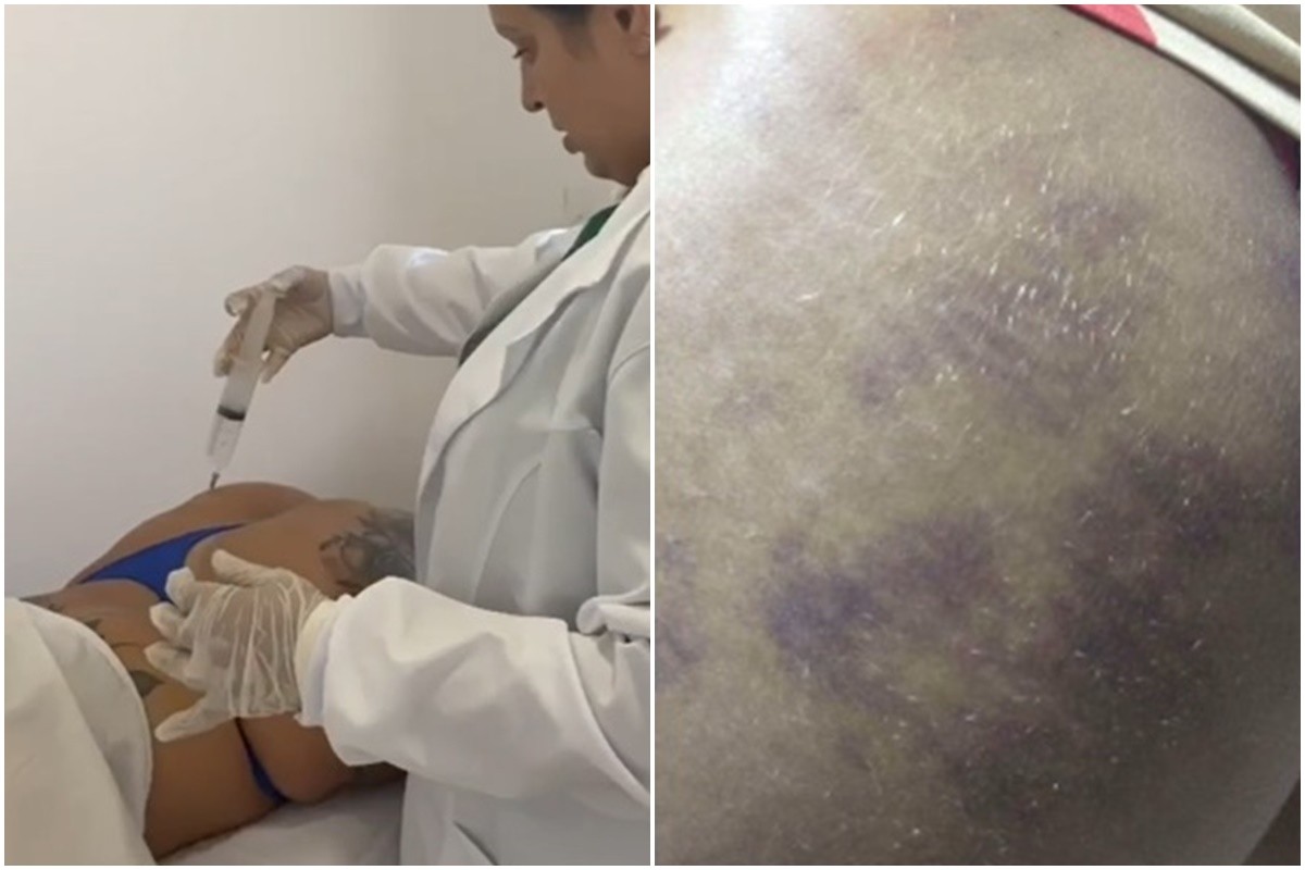 Falsa médica é presa em João Pessoa suspeita de harmonização de glúteos irregular