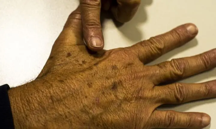 Lacunas em dados sobre câncer de pele prejudicam políticas e diagnóstico