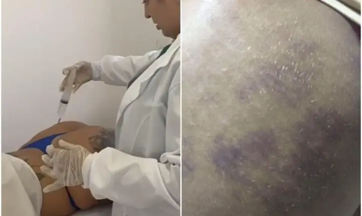Falsa médica é presa em João Pessoa suspeita de harmonização de glúteos irregular
